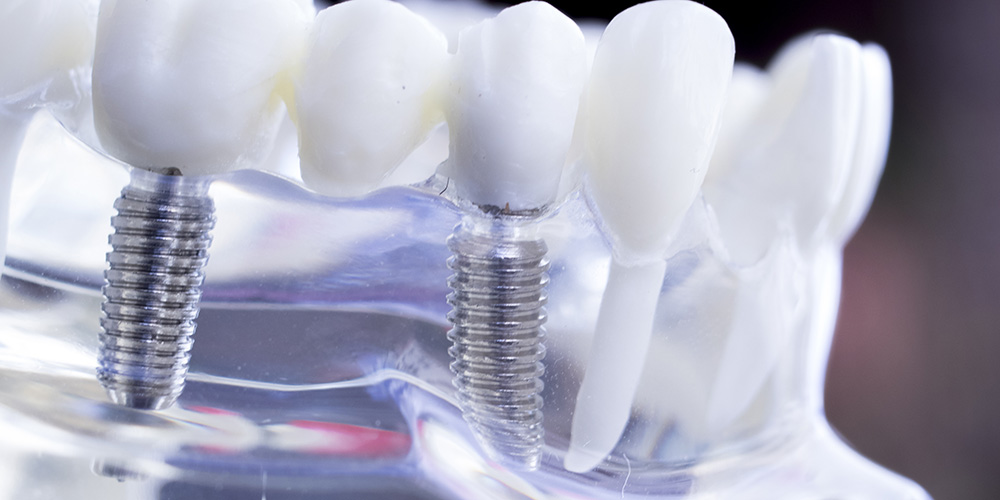 Dental Implants