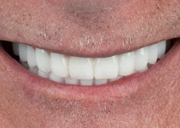 Diş İmplantlarınız Ne Kadar Süre Dayanır?