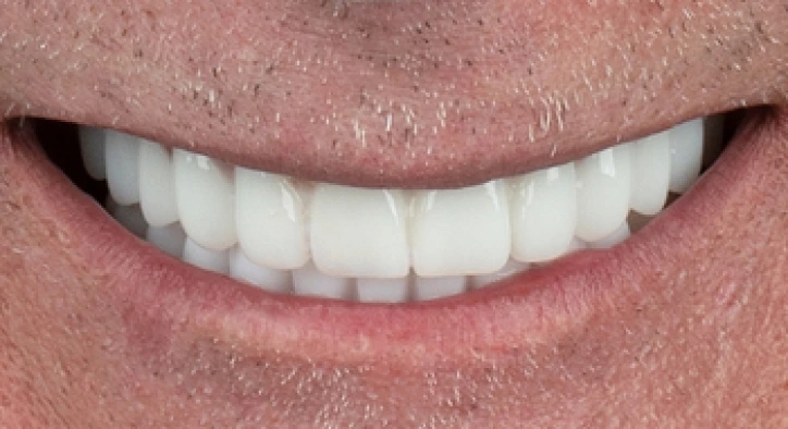 Diş İmplantlarınız Ne Kadar Süre Dayanır?