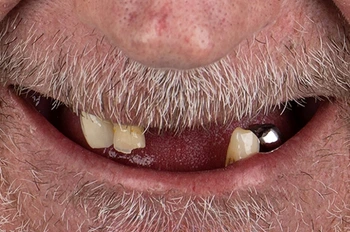 All on 6 İmplant Öncesi