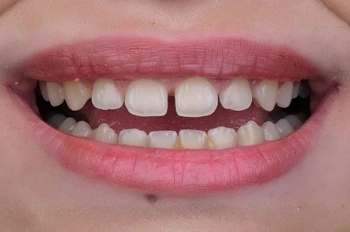 Dental Bonding Öncesi