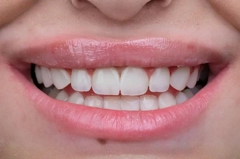 Dental Bonding Sonrası