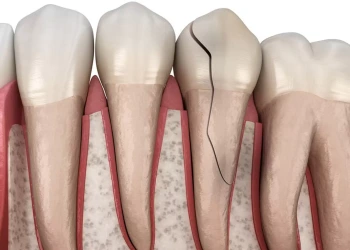 Çatlak Diş Belirtileri Nelerdir? Tedavi Edilmezse Ne Olur?