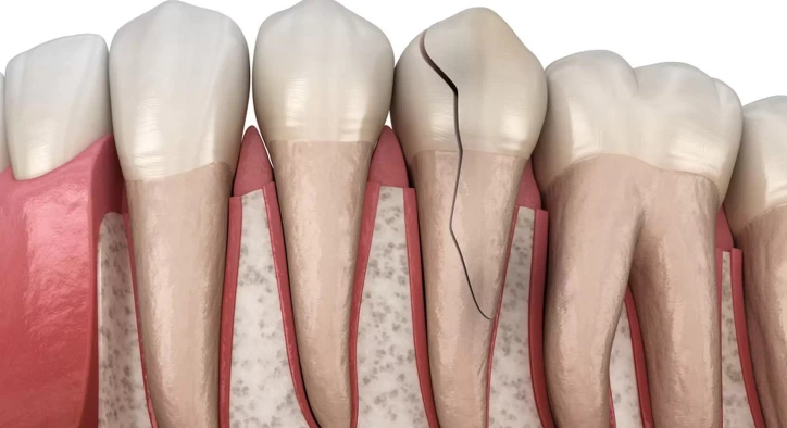 Çatlak Diş Belirtileri Nelerdir? Tedavi Edilmezse Ne Olur?