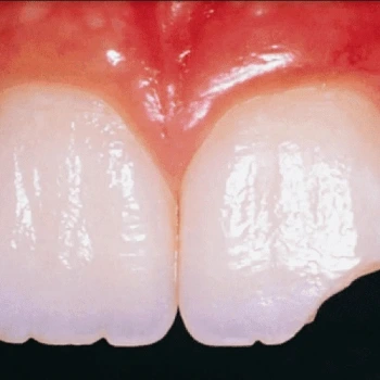 Dental Travma Tedavisi ve Takibi