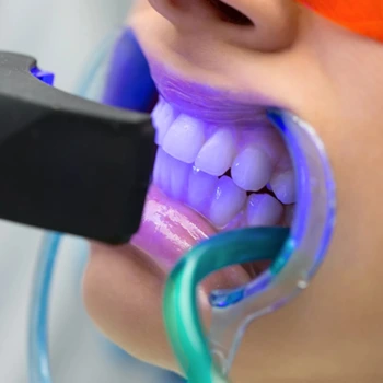 Devital Bleaching