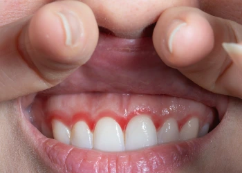 Diş Eti Çekilmesi Nedir?