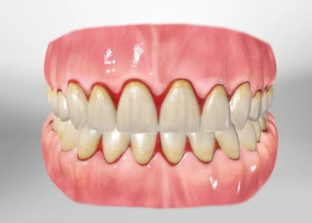 Diş Eti Kanaması Neden Olur, Hangi Durumlarda Tehlikelidir?