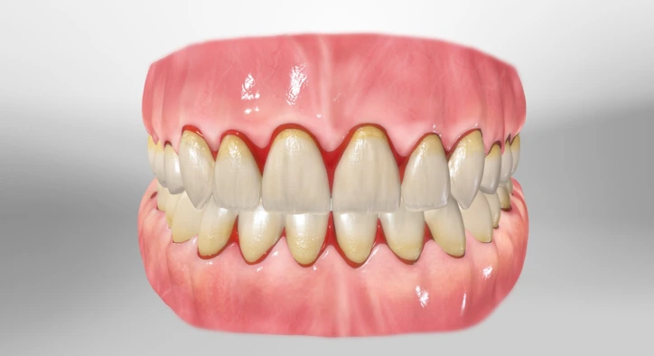 Diş Eti Kanaması Neden Olur, Hangi Durumlarda Tehlikelidir?