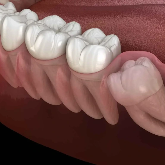 Gömülü 20'lik Diş Çekimi