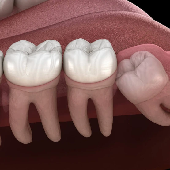 Gömülü 20'lik Diş Çekimi