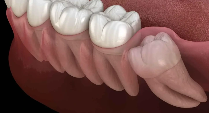 Gömülü Diş Nedir? Belirtileri, Tedavisi ve Çekim Süreci