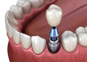 Dental Implant