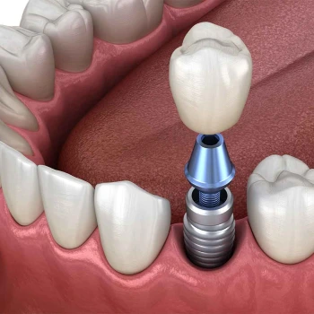 İmplant Tedavisi