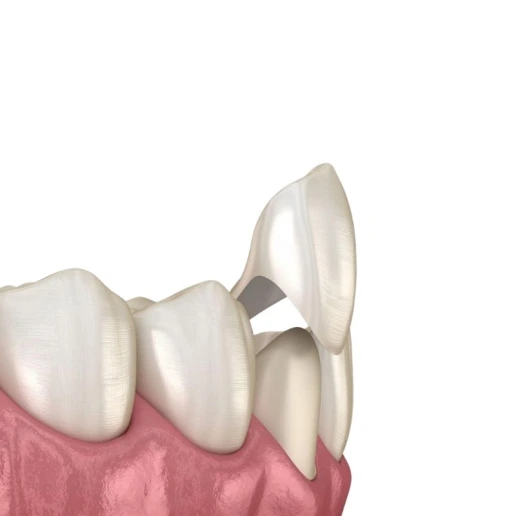 Porselen Diş Kaplama