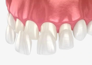 Porselen Diş Kaplama Nedir, Nasıl Yapılır?