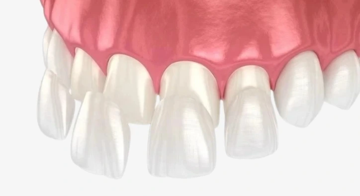 Porselen Diş Kaplama Nedir, Nasıl Yapılır?