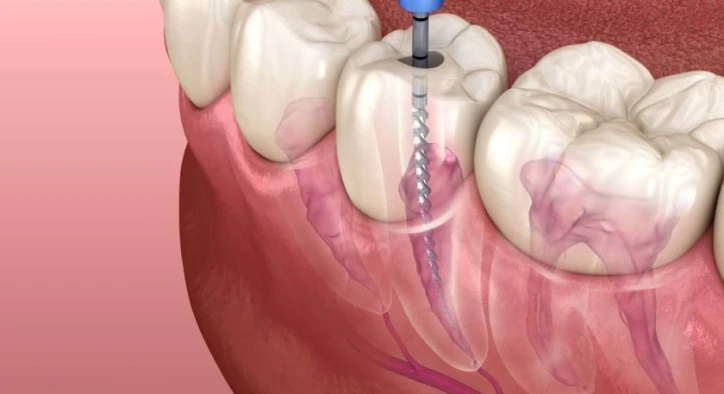 Kanal Tedavisi Nedir, Ne Kadar Sürer ve Ağrılı mıdır?