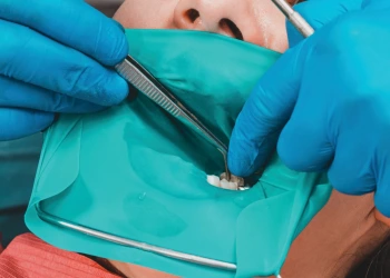 Wurzelkanalbehandlung mit Kofferdam