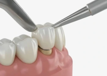 Diş Kaplaması Türleri ve Fiyatları