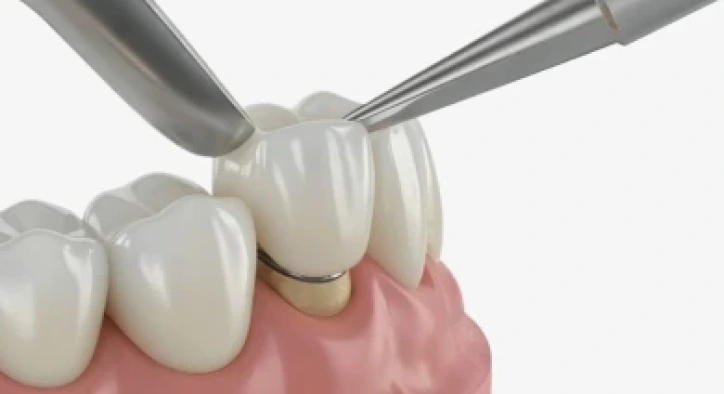 Diş Kaplaması Türleri ve Fiyatları