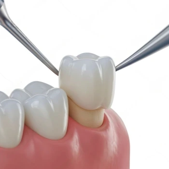 Zirkonyum Diş Kaplama