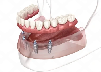 All on 4 İmplant Tekniği Nedir?