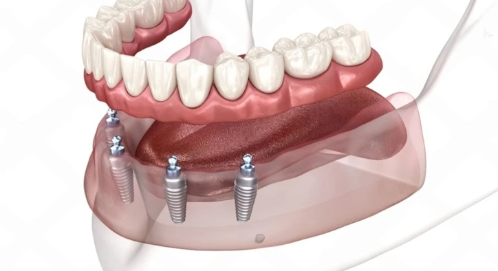 All on 4 İmplant Tekniği Nedir?