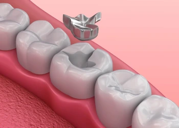 Amalgam Dolgu Nedir? Zararları Nelerdir?