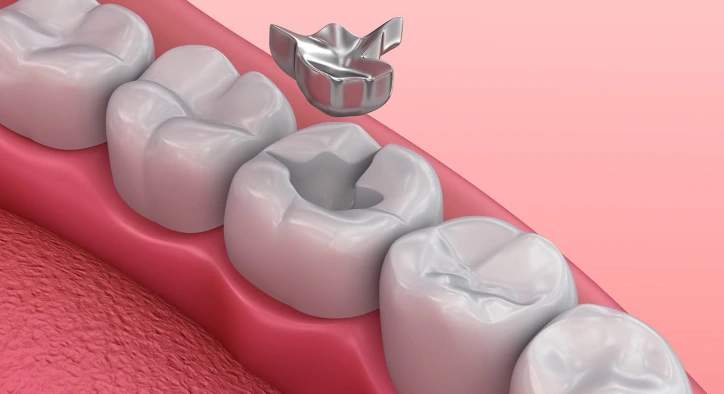 Amalgam Dolgu Nedir? Zararları Nelerdir?