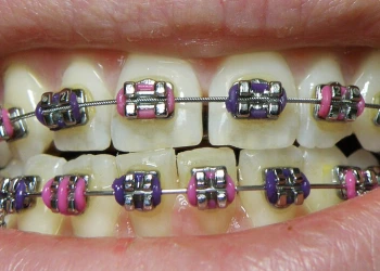 Braket Nedir? Çeşitleri Nelerdir? Ortodontide Braket Sistemlerine Bilimsel Bir Bakış
