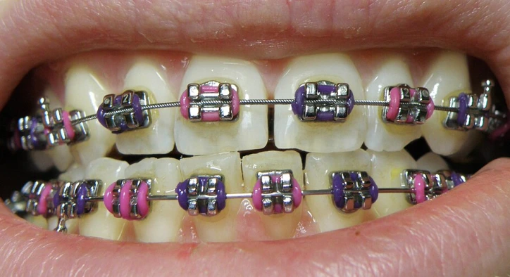 Braket Nedir? Çeşitleri Nelerdir? Ortodontide Braket Sistemlerine Bilimsel Bir Bakış