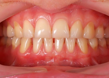 Dikkat Edilmesi Gereken Diş Eti Çekilmesinin 5 Aşaması