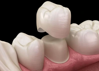 Diş Kronu Onarımı: İşlem Aşamaları ve Maliyet Açıklaması