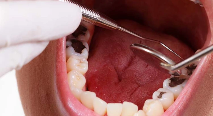 Diş Siniri Ölmesi Nedir, Neden Olur ve Nasıl Tedavi Edilir?