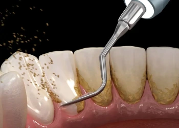 Diş Taşı Temizliği Sonrası Nelere Dikkat Edilmeli?