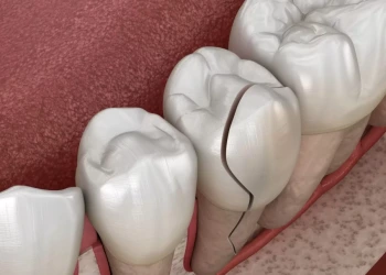 Endodontik Tedavi Nedir ve Nasıl Yapılır?