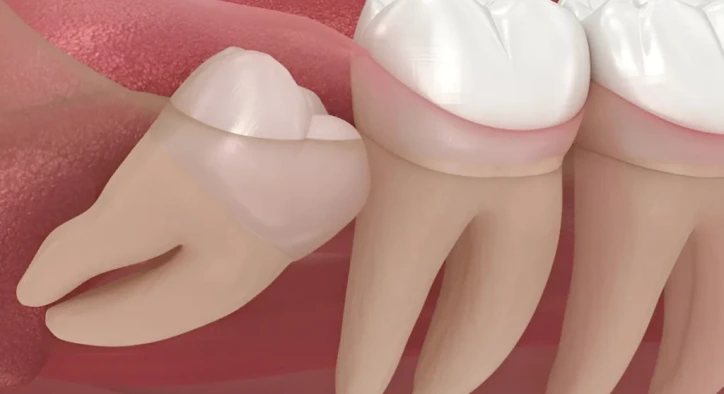 Gömülü Diş Nedir? Gömülü Diş Ameliyatı Nasıl Yapılır?