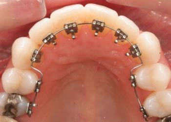 Görünmez Diş Teli Tedavisi & Seramik Braketler