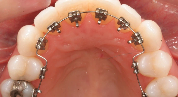 Görünmez Diş Teli Tedavisi & Seramik Braketler