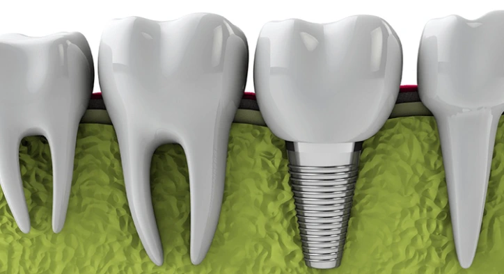 Diş İmplantı Türleri Ve Tedaviye Müsait Durumlar