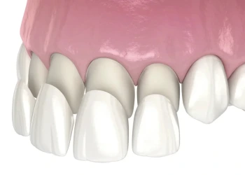 Diş Kaplaması Türleri ve Fiyatları