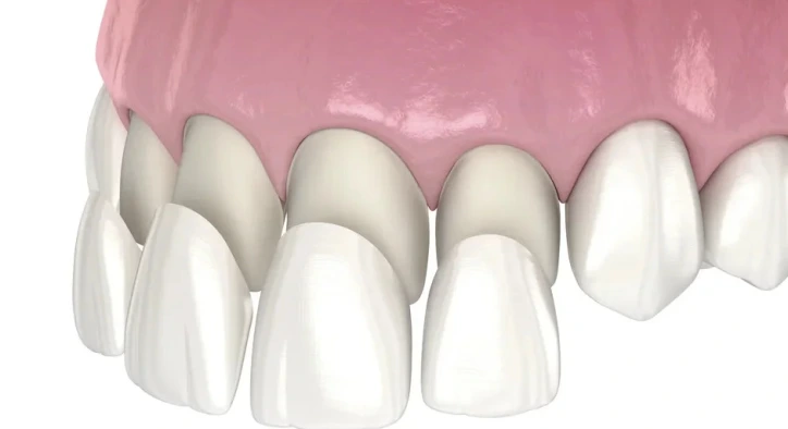 Diş Kaplaması Türleri ve Fiyatları