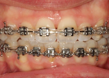 Metal Diş Teli: Avantajları, Fiyatları ve Çeşitleri
