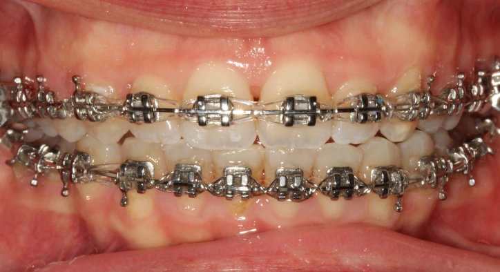 Metal Diş Teli: Avantajları, Fiyatları ve Çeşitleri