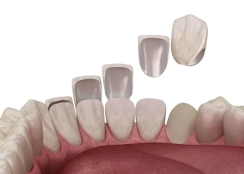 Diş Kaplama Nasıl Yapılır?