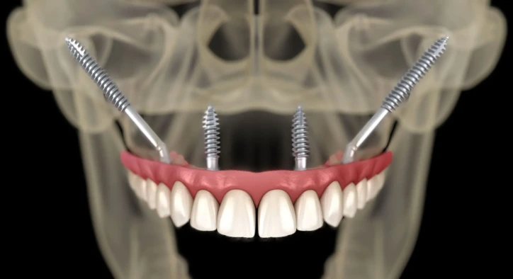 Zigomatik İmplant Nedir? Avantajları Nelerdir?