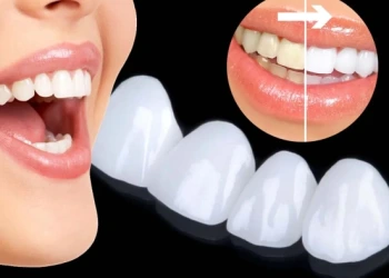 Diş Kaplamalarının Bilmeniz Gereken Olası Tehlikeleri ve Riskleri!