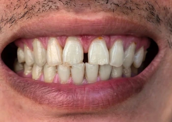 Ayrık Diş Tedavisi Nedir ve Nasıl Yapılır?