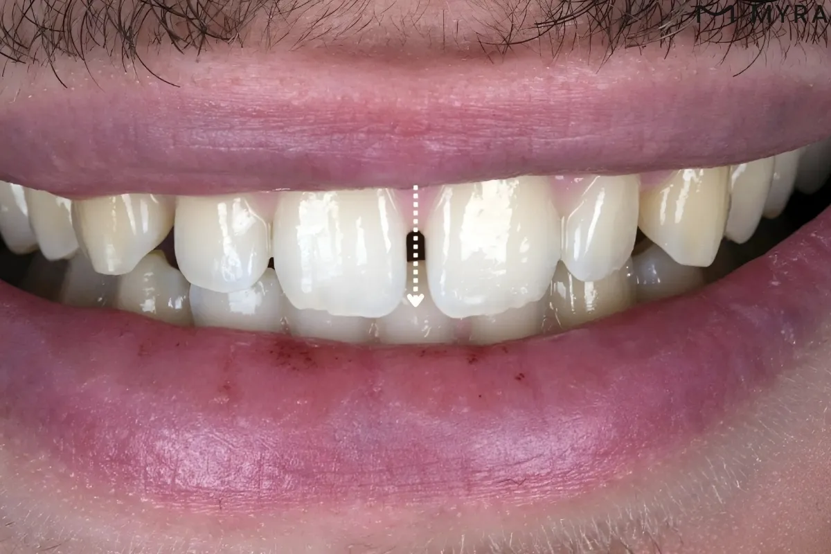 Ayrık Diş Tedavisi Nedir ve Nasıl Yapılır?